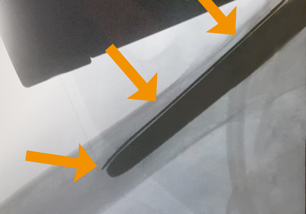 endocon Cement-free revisions with OrthoClast