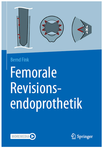 Femorale Revisionsendoprothetik. Prof. Dr. med. Bernd Fink Verweist auf das OrthoClast System.